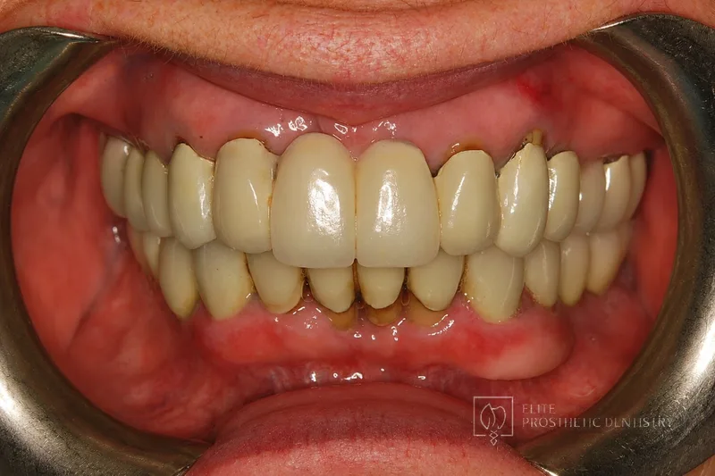 Before: retracted view of aging crowns and bridgework with darkened gum-line margins
