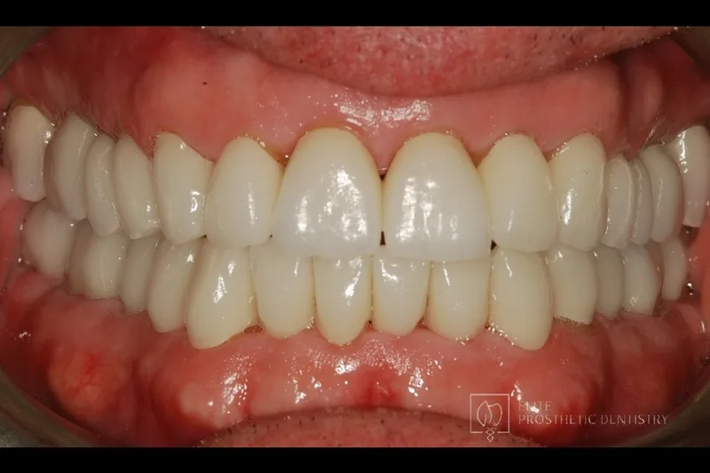 After: retracted view following coordinated replacement of aging restorations