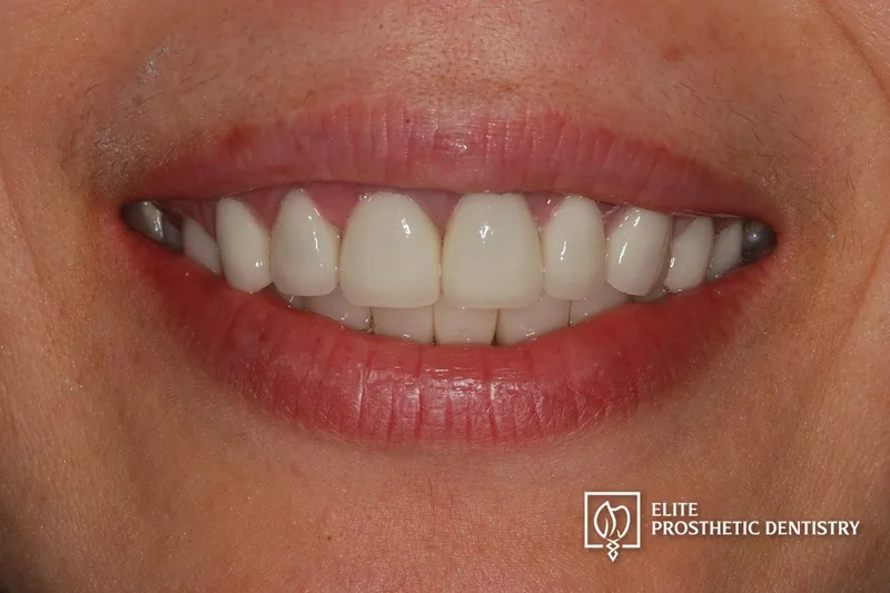 After: smile with customized ceramic restorations designed for natural esthetics