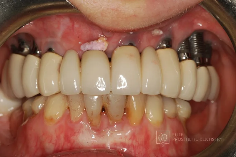 Before: failing upper implants with exposed implant components and deteriorating bridgework