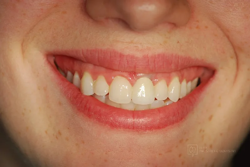 After: smile with the front tooth replaced by a natural-looking implant crown