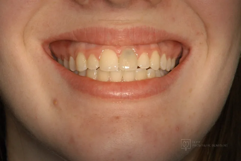 Before: smile with a discolored, failing front tooth