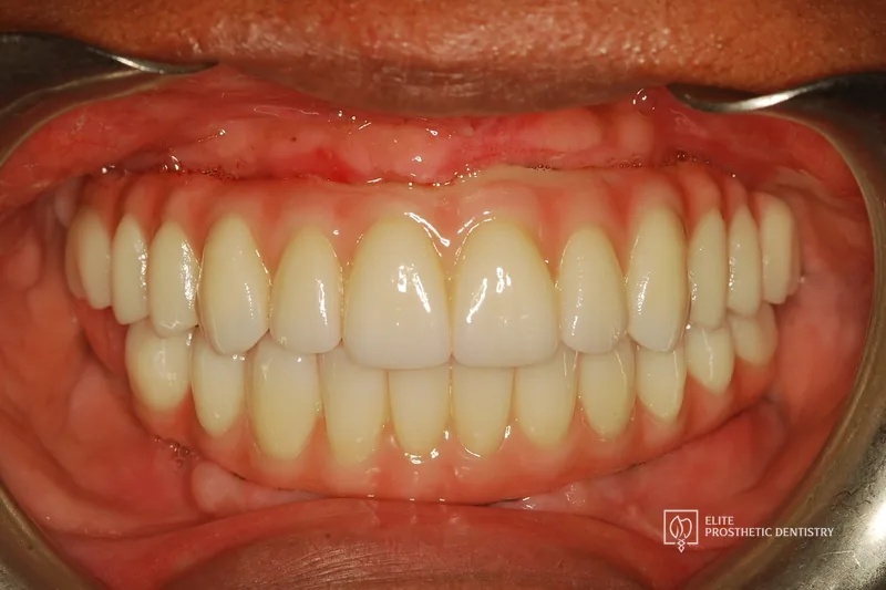 After: retracted view of the completed full-arch implant-supported zirconia prosthesis