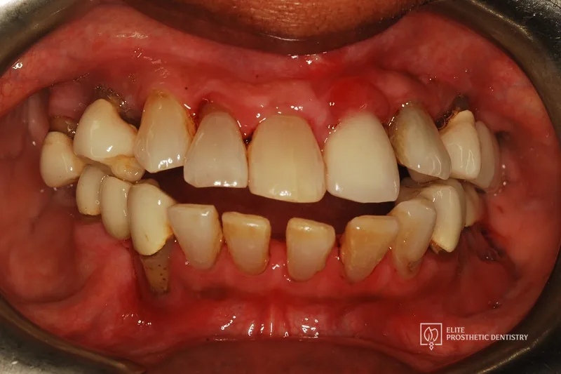 Before: retracted view of worn, spaced, and discolored teeth before full-arch implant treatment