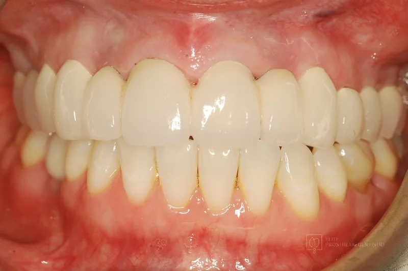 After: retracted view of redesigned implant crowns with natural proportions