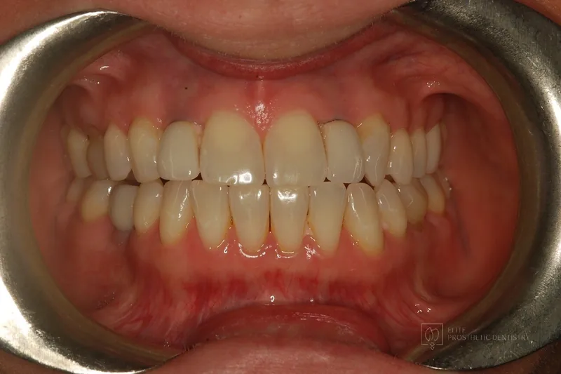 Before: retracted view of older implant crowns with a short, uneven appearance