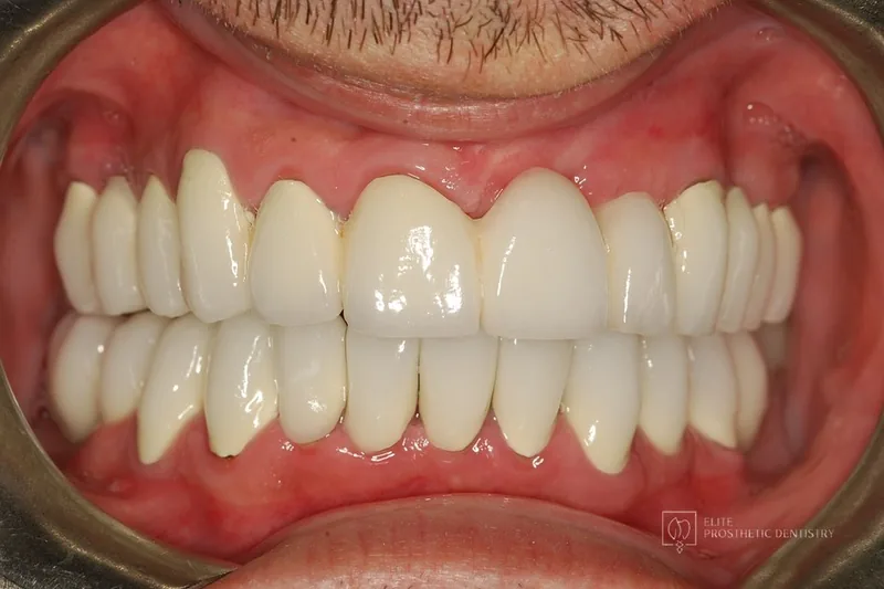 After: retracted view following coordinated full-mouth reconstruction