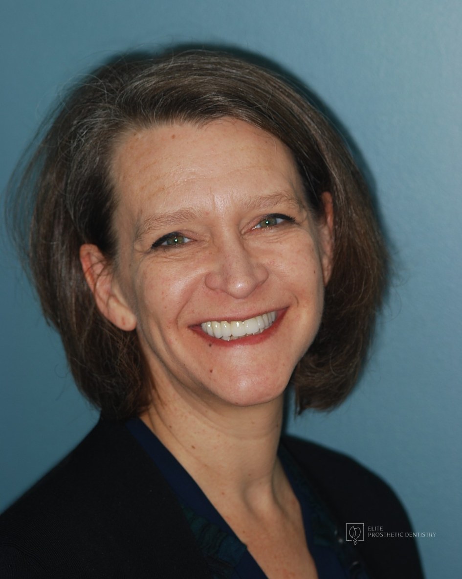 Patient after completion of the implant-supported reconstruction, smiling naturally with the rebuilt upper bridge and restored lower arch