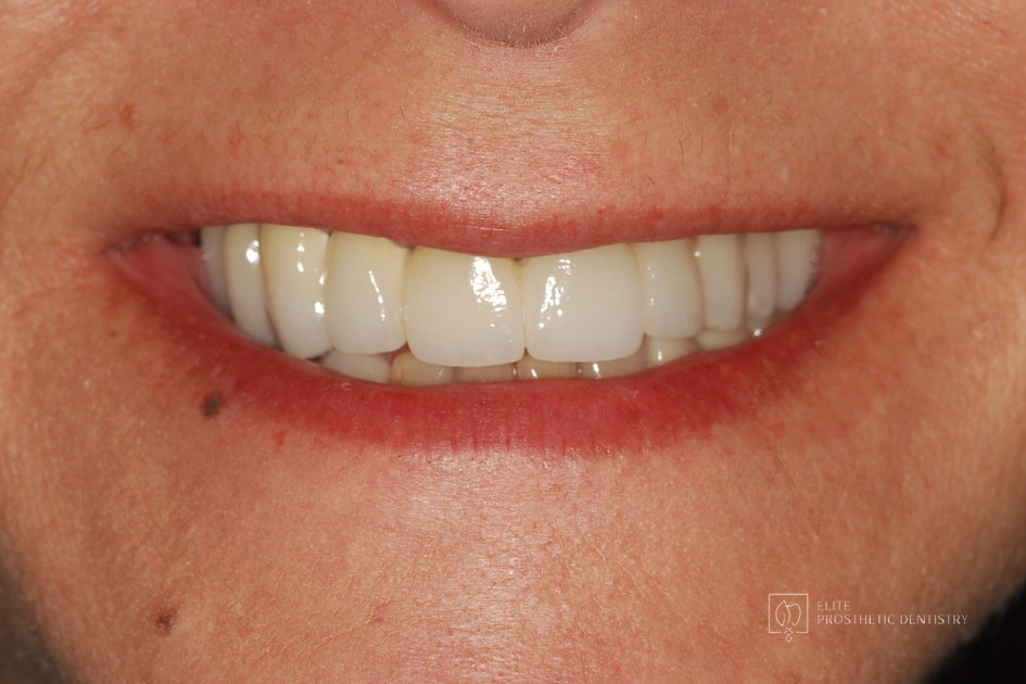After: Implant Supported Reconstruction: Failing Bridgework and Missing Back Teeth Rebuilt with Coordinated Specialist Care