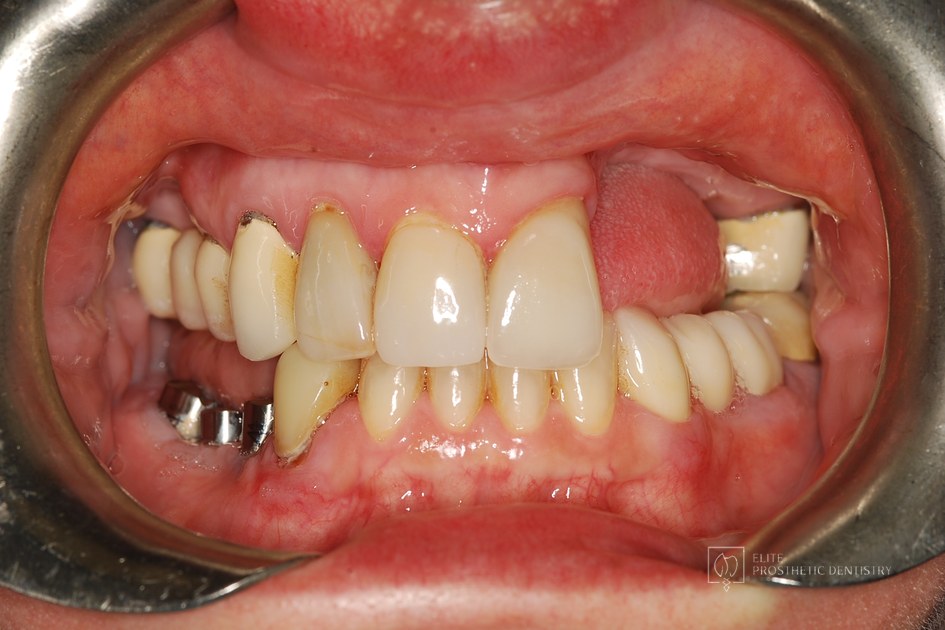 Before: retracted intraoral view showing the resorbed upper left ridge, broken-down lower teeth, and failing dental work
