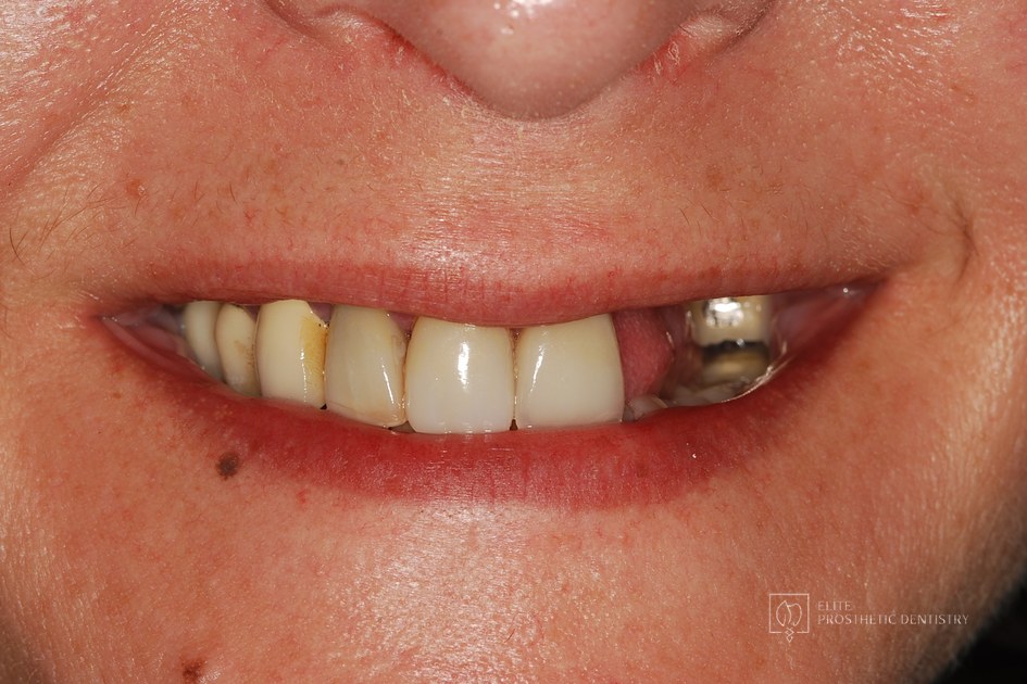 Before: Implant Supported Reconstruction: Failing Bridgework and Missing Back Teeth Rebuilt with Coordinated Specialist Care