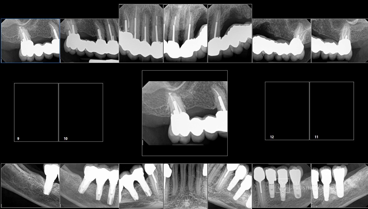 Post-treatment full-mouth radiographic series documenting the seated long-span upper bridge and the lower implants in supporting bone after implant-supported reconstruction at Elite Prosthetic Dentistry in Washington, DC