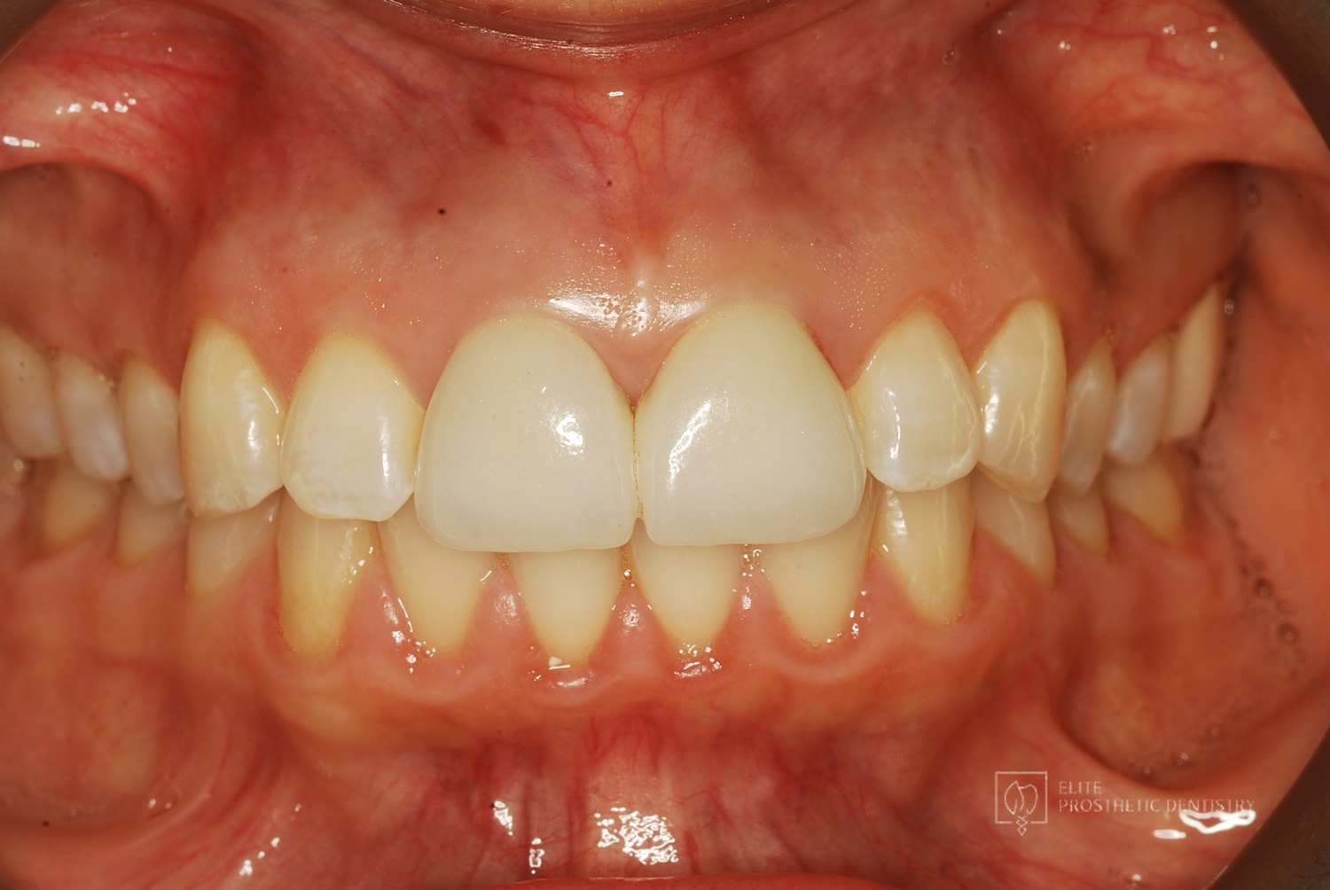 After: Two Front Teeth Saved From Extraction: A Second Opinion, Custom Gold Posts, and Crowns Made to Last