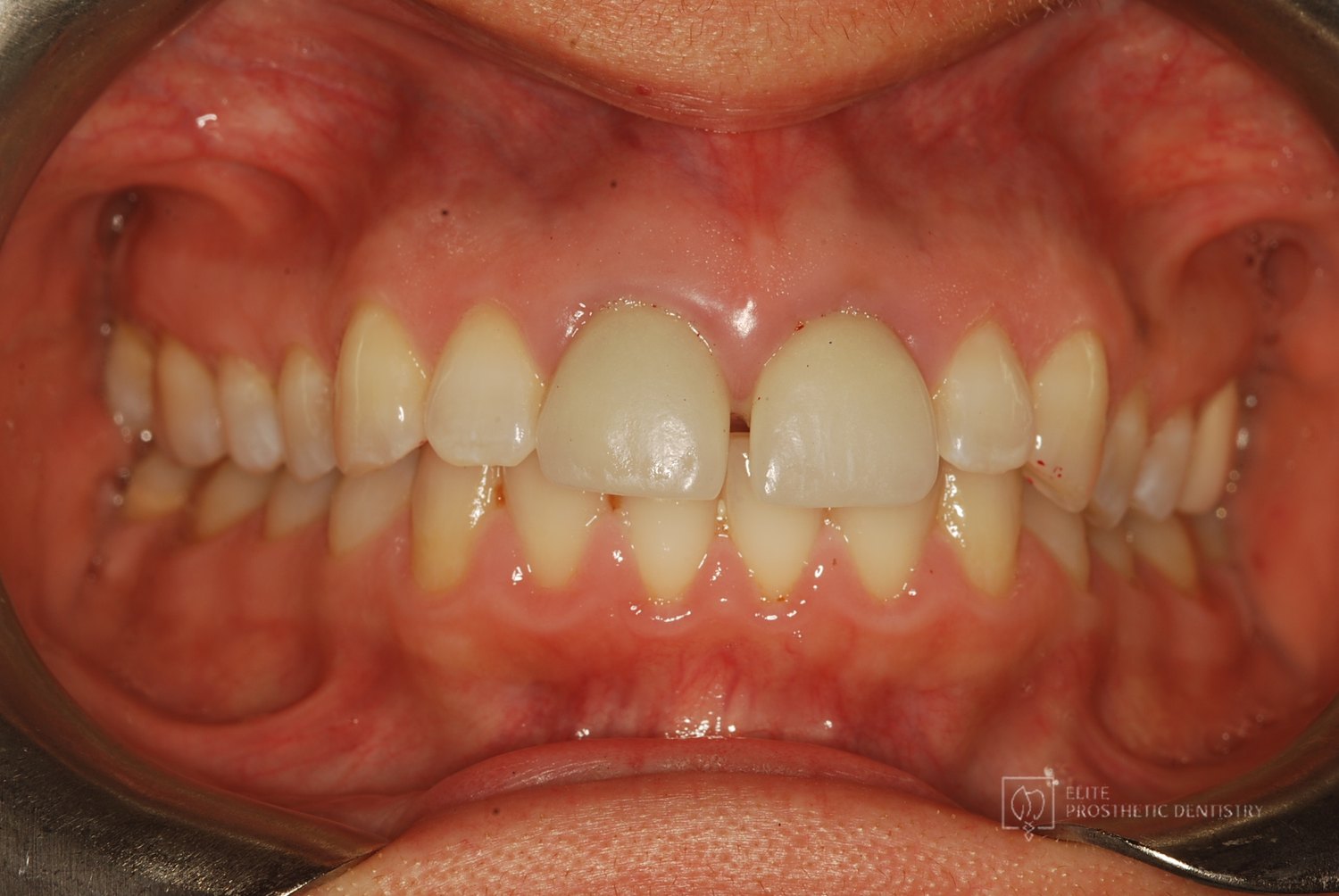 Before: Two Front Teeth Saved From Extraction: A Second Opinion, Custom Gold Posts, and Crowns Made to Last