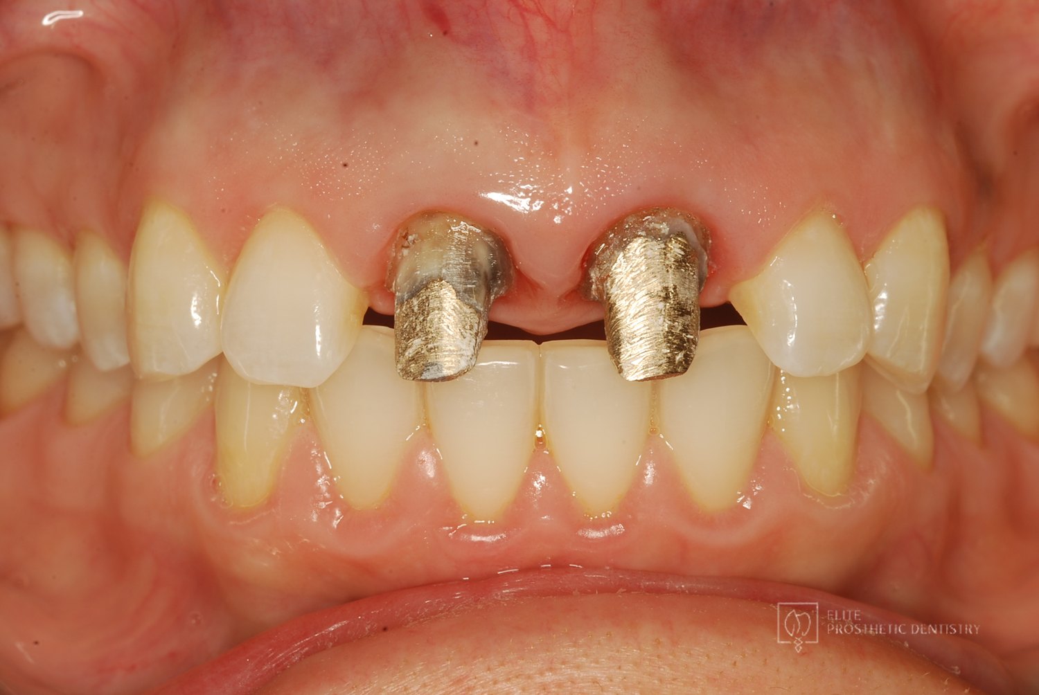 Two custom lab-fabricated gold posts seated in the prepared roots of the upper front teeth
