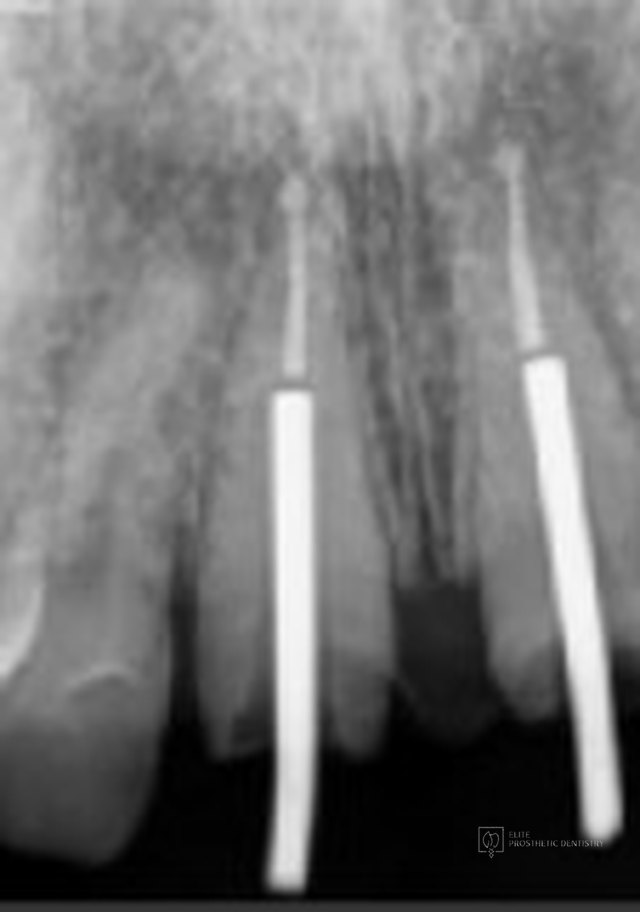 Radiograph showing the two custom gold posts seated within the retreated roots