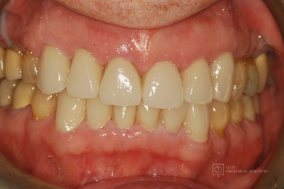 After: retracted intraoral view following reconstruction of the worn dentition with custom ceramic crowns