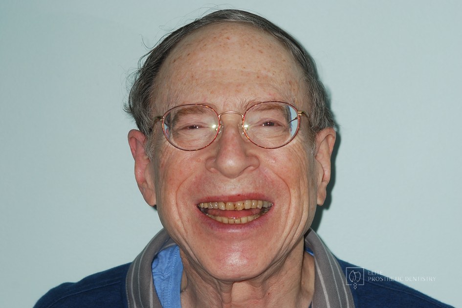 Before: Repairing the Worn Out Dentition: How Severely Worn Teeth Were Rebuilt for Long-Term Function