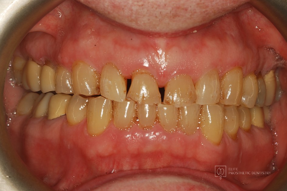 Before: retracted intraoral view documenting severe wear, flattened shortened edges, chipping, and darkened tooth structure