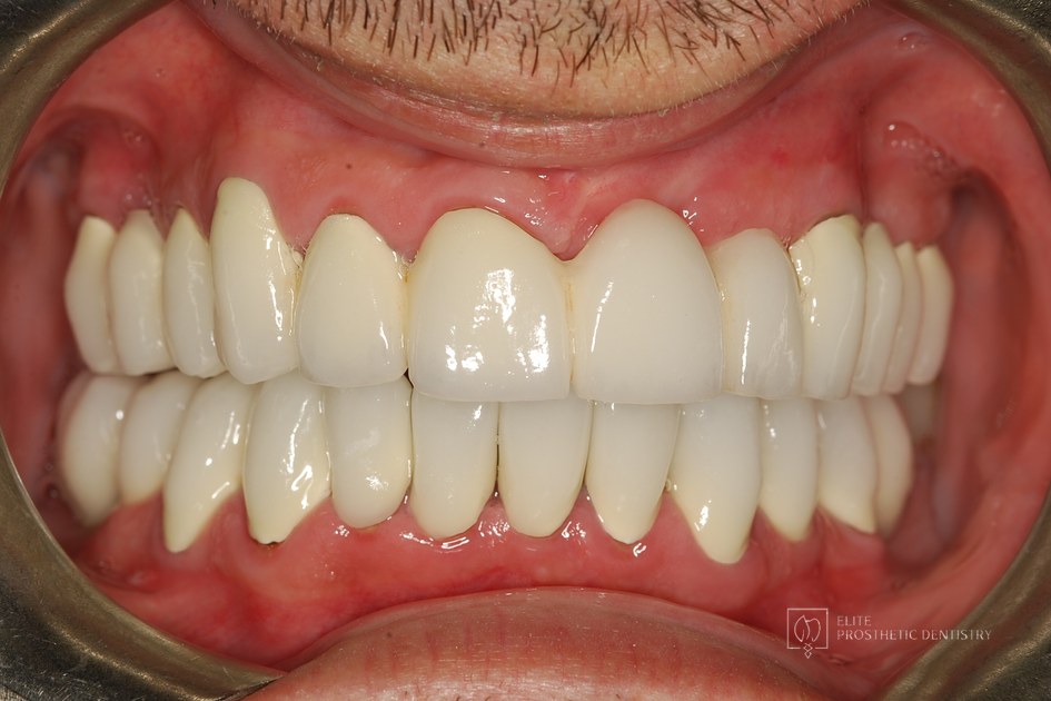 After: retracted intraoral view following the coordinated reconstruction with fixed implant-supported and tooth-supported bridges