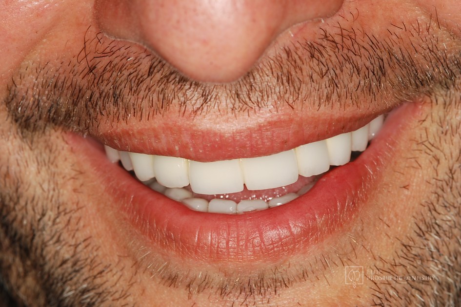 After: Severe Restorative Breakdown Rebuilt with a Coordinated Full-Mouth Reconstruction