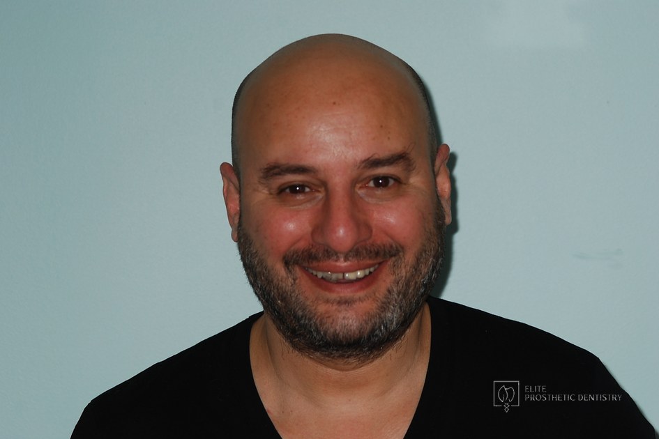 Before: full-face view during the diagnostic phase, prior to full-mouth reconstruction for severe restorative breakdown