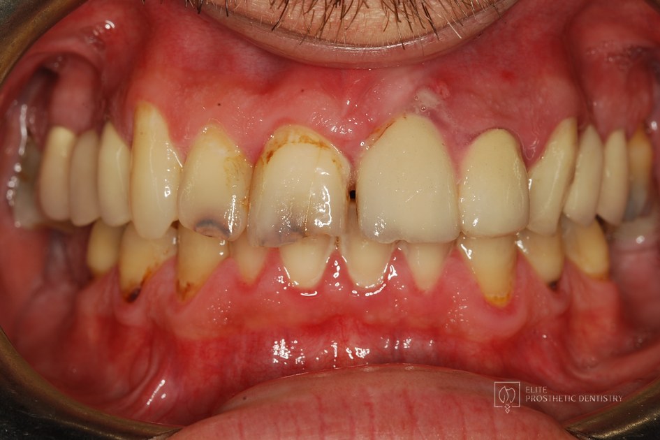 Before: retracted intraoral view documenting decay, breakdown, and inflamed tissue around older mismatched restorations