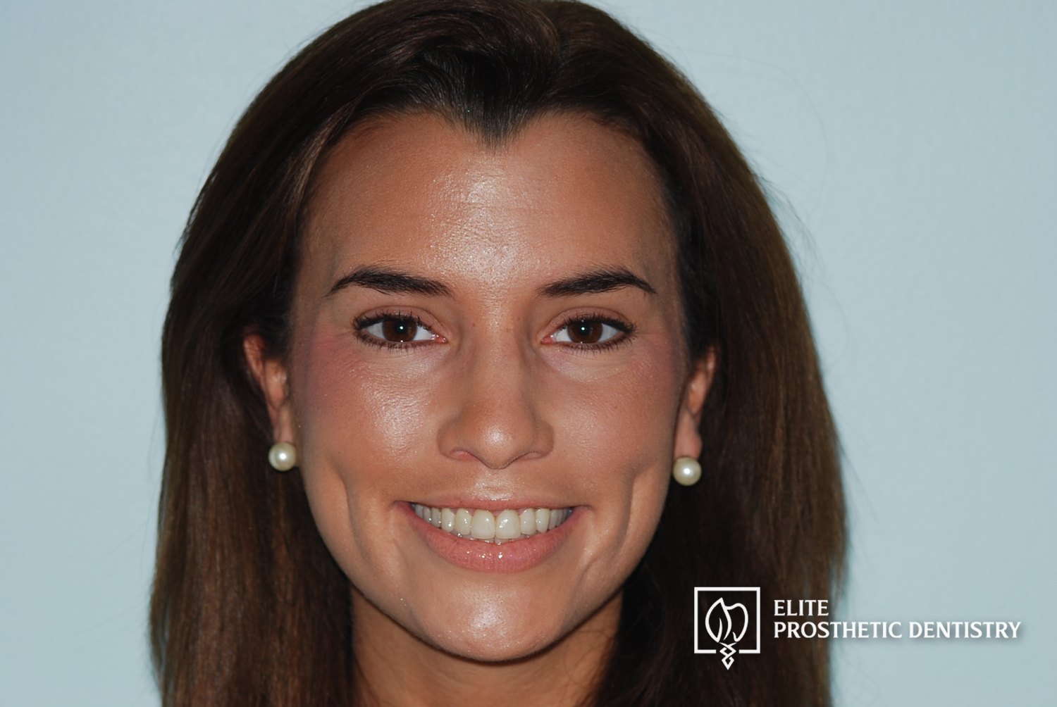 After: How Severely Worn Upper Teeth Were Rebuilt Into a More Stable, Natural-Looking Result