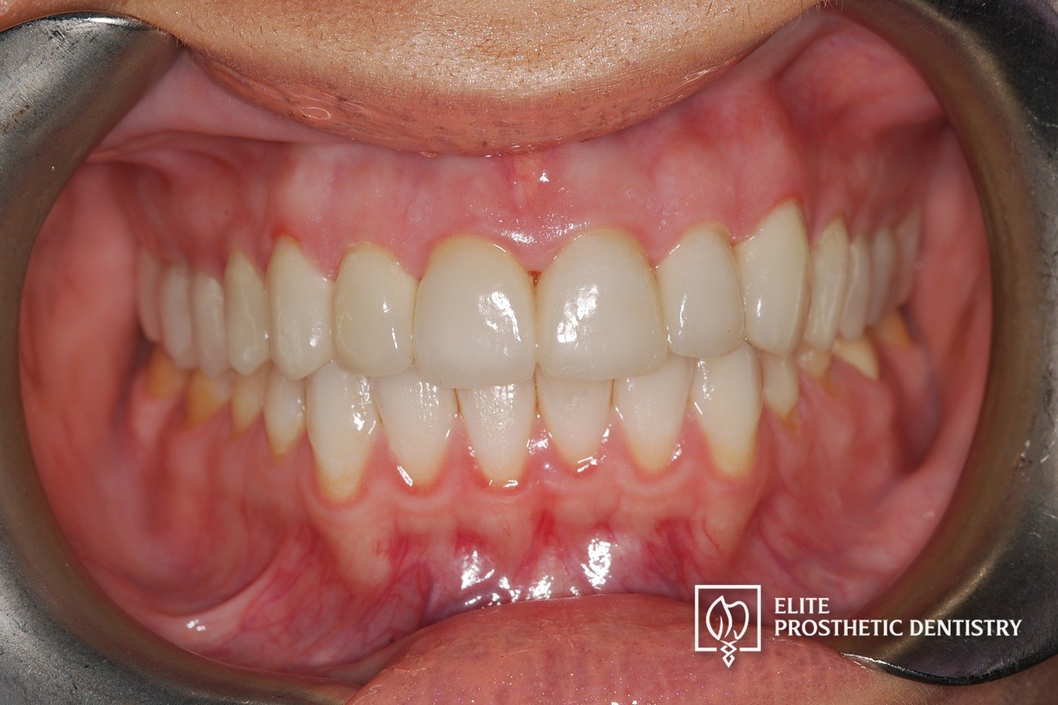 After: retracted intraoral view following full upper-arch reconstruction with restored tooth length and balanced occlusion