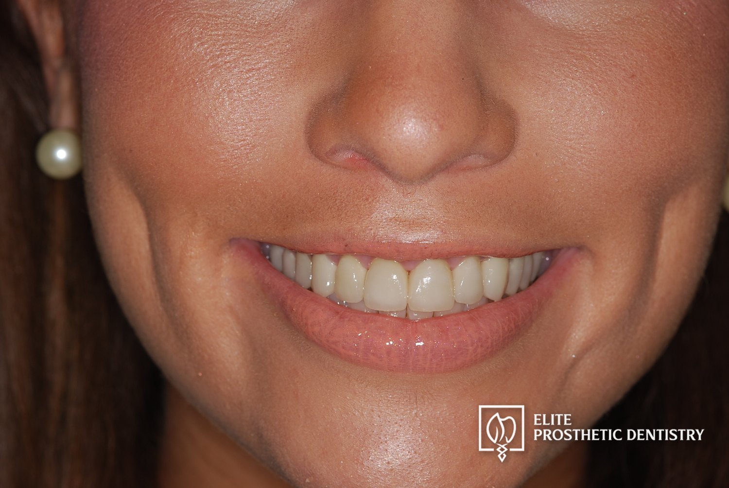 After: smile rebuilt with restored tooth length and natural proportions