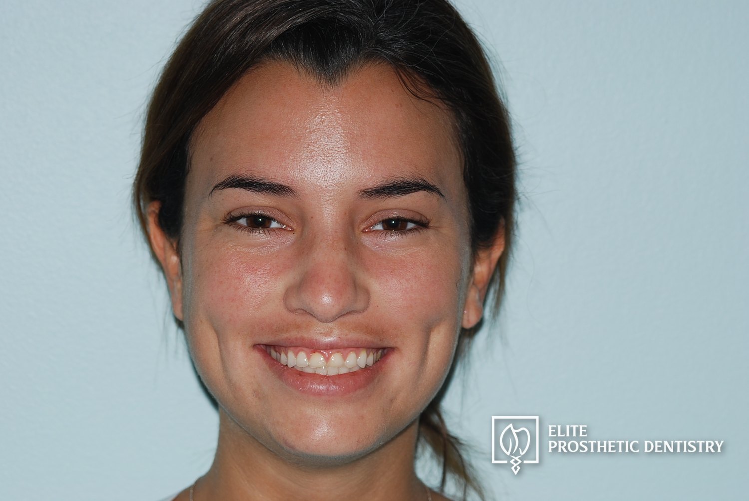 Before: How Severely Worn Upper Teeth Were Rebuilt Into a More Stable, Natural-Looking Result