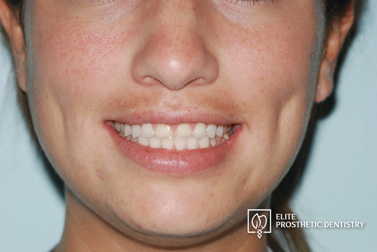 Before: close-up smile showing severely worn, shortened upper front teeth