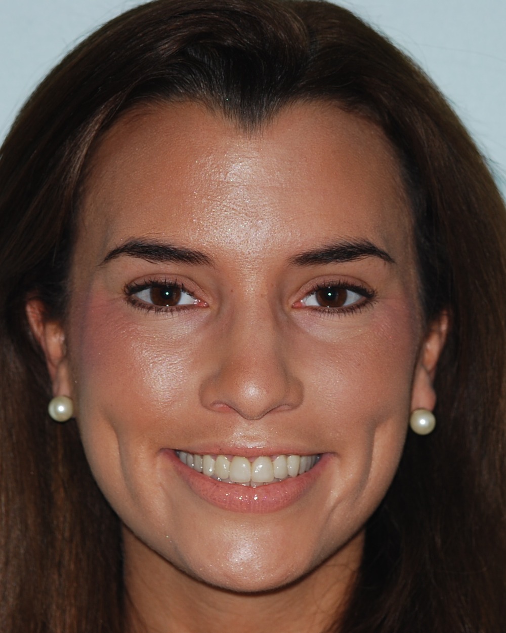 After: How Severely Worn Upper Teeth Were Rebuilt Into a More Stable, Natural-Looking Result