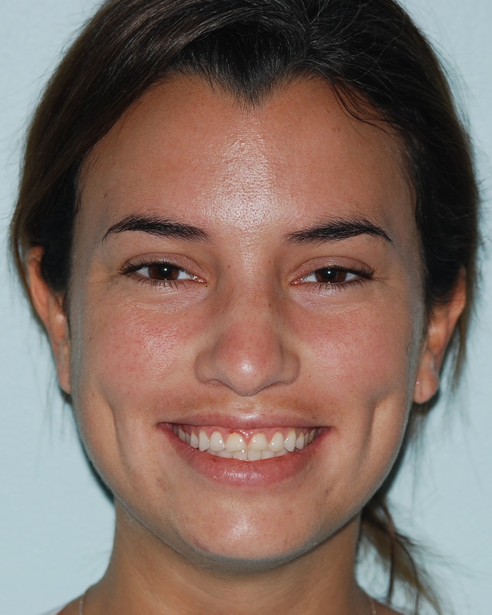 Before: How Severely Worn Upper Teeth Were Rebuilt Into a More Stable, Natural-Looking Result