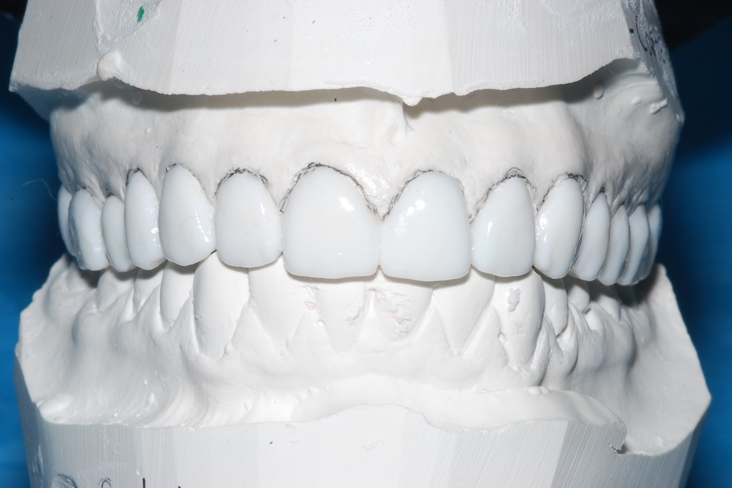 Custom wax-up created before treatment to preview the planned shape, length, and