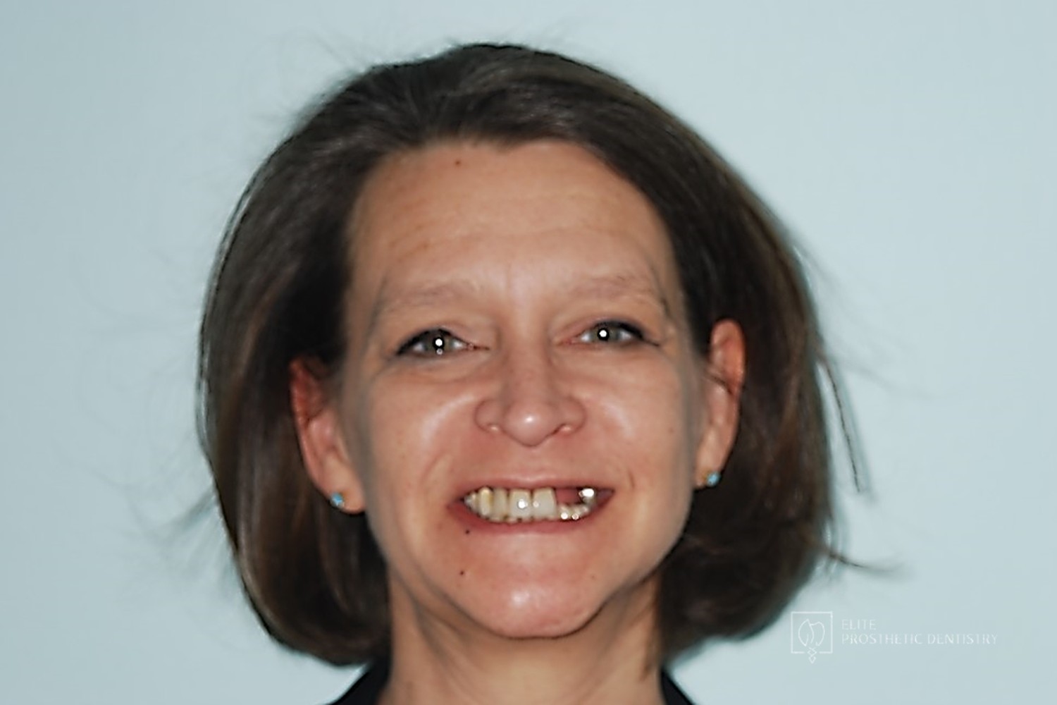 Before: full-face view before the implant-supported reconstruction, with failing upper-left dental work visible in the smile