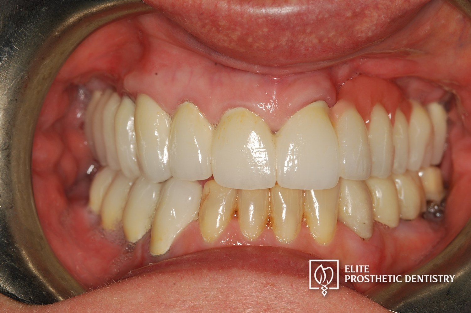 After: retracted intraoral view following coordinated surgical, endodontic, and prosthodontic rebuild
