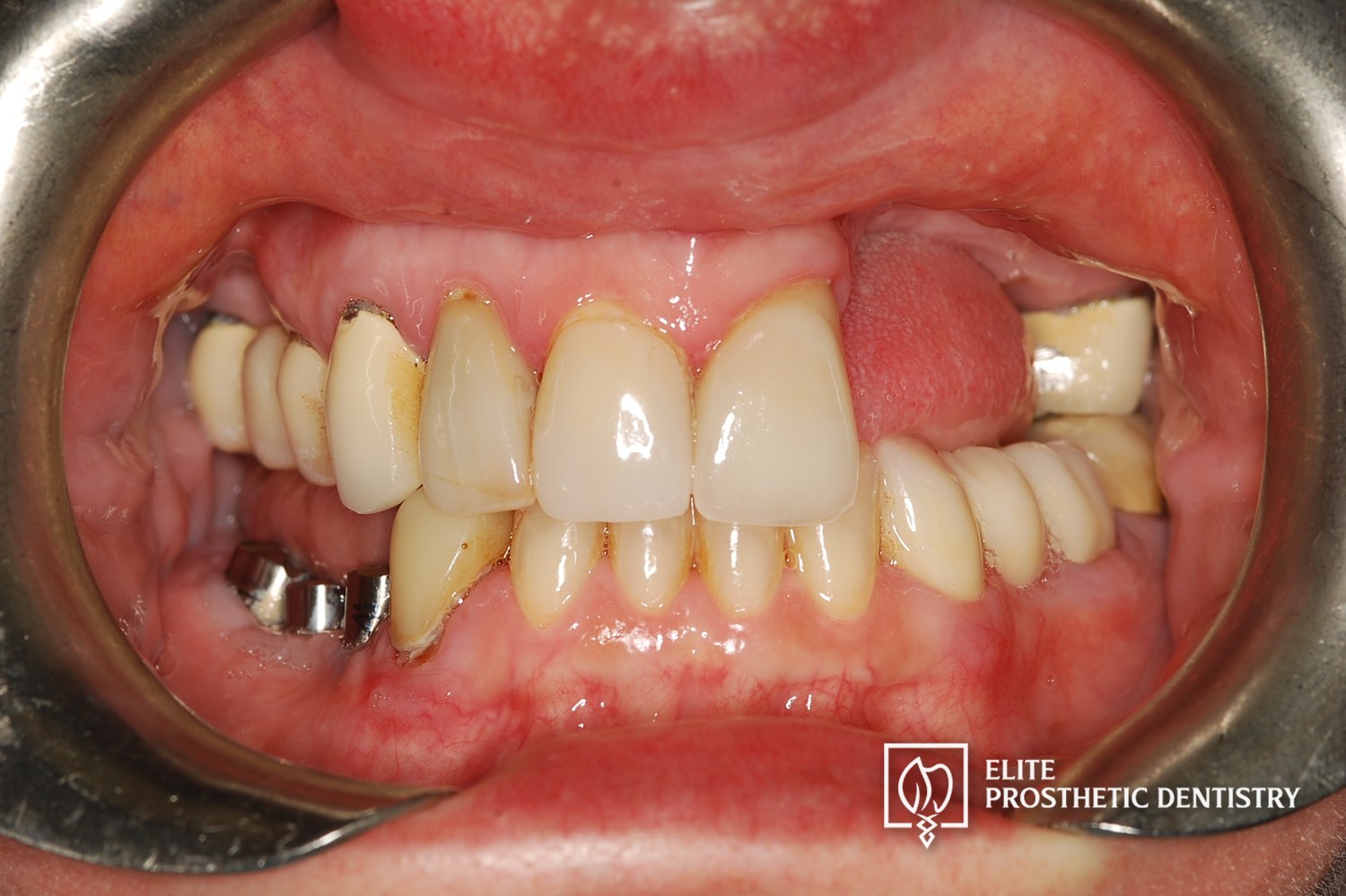 Before: retracted intraoral view showing severe bone loss on the upper left and failing lower posterior teeth