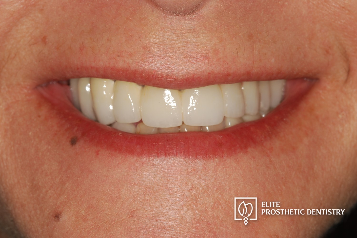 After: close-up smile following the coordinated upper bridge and lower implant reconstruction