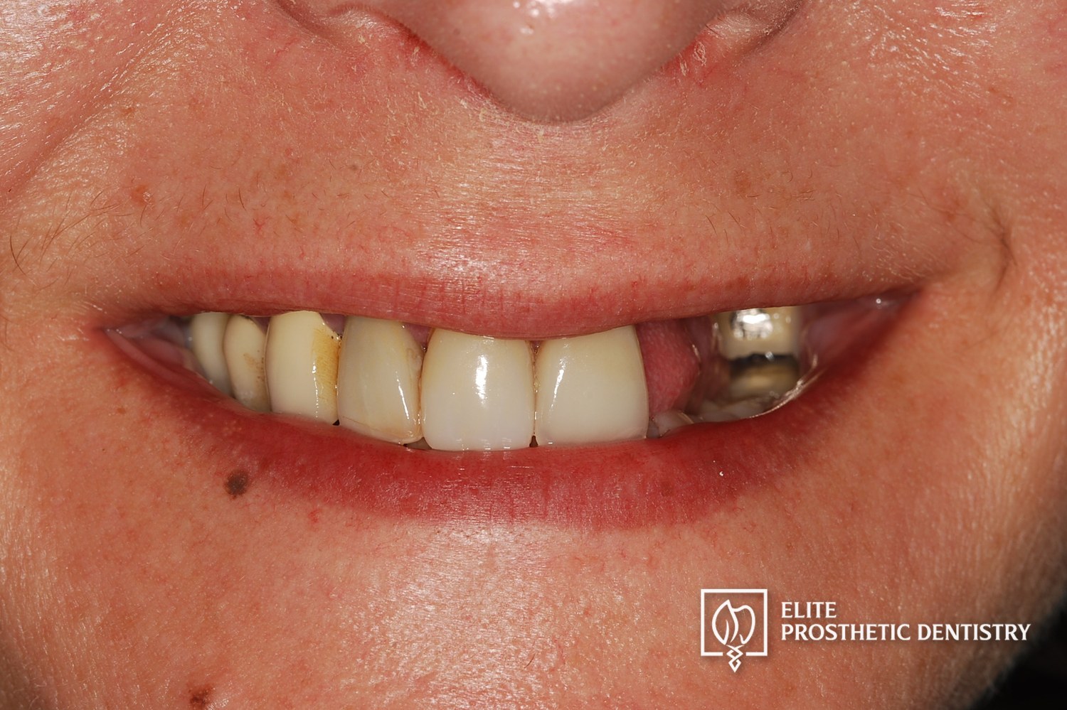 Before: close-up smile showing the failing upper bridge and compromised dentition