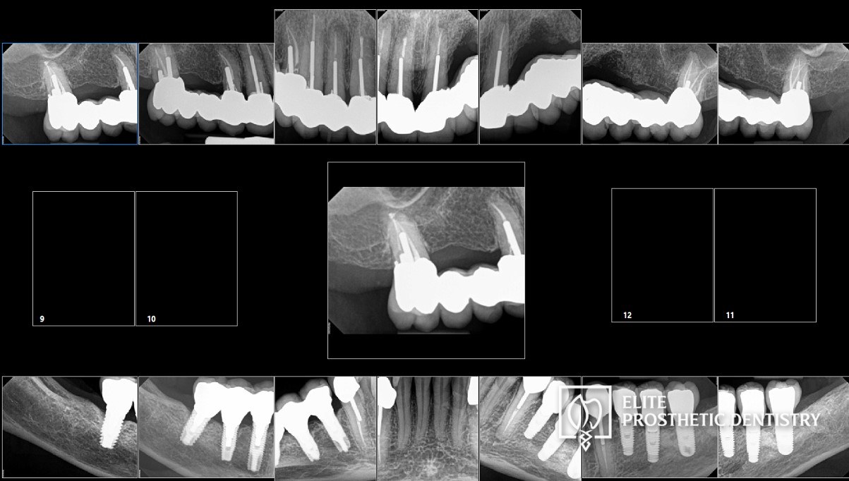 Post-treatment full-mouth radiographic series documenting the completed upper bridge and lower implant reconstruction at Elite Prosthetic Dentistry in Washington, DC