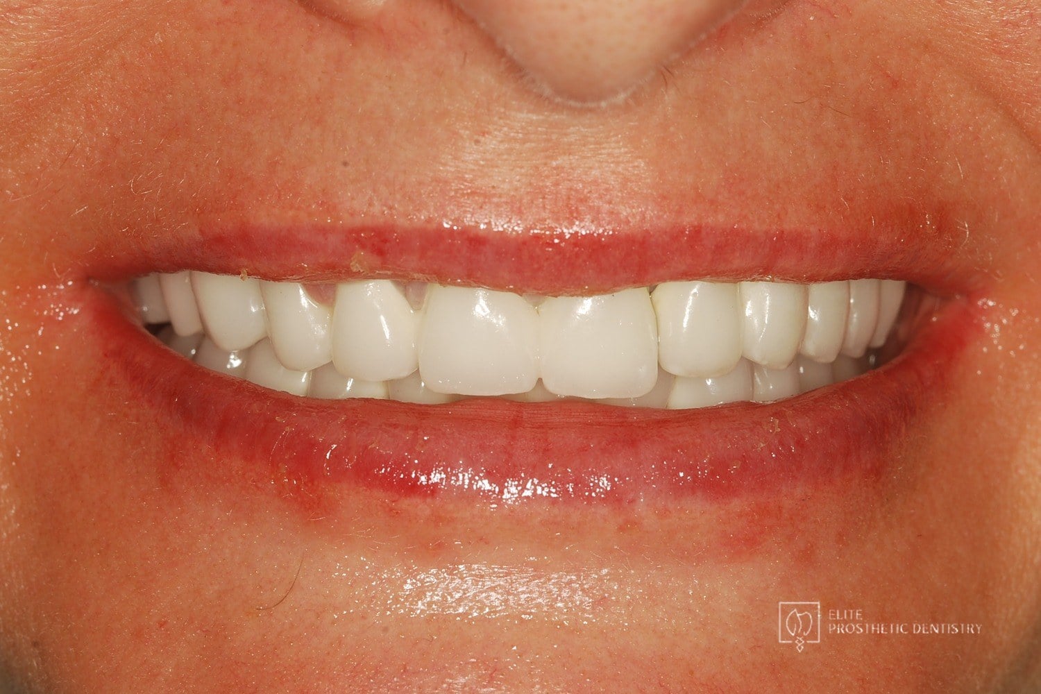After: How Aging, Failing Dentistry Was Replaced with a Coordinated Full-Mouth Implant and Crown Reconstruction
