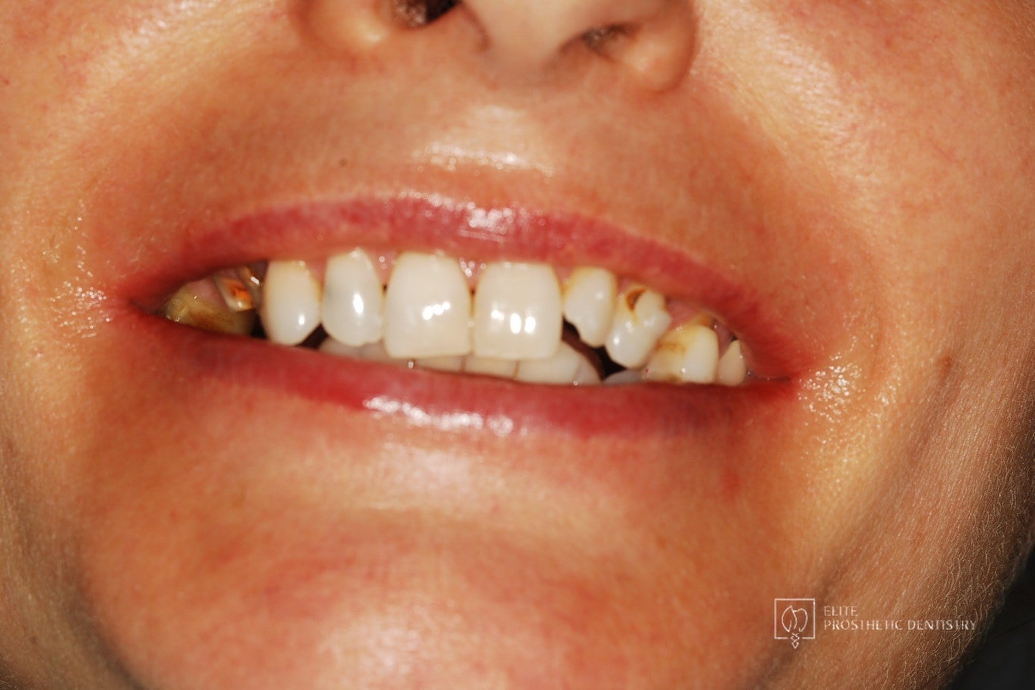 Before: How Aging, Failing Dentistry Was Replaced with a Coordinated Full-Mouth Implant and Crown Reconstruction
