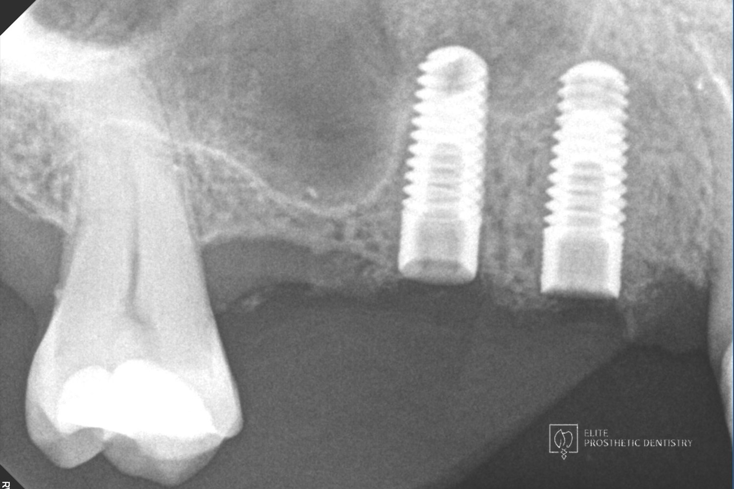 Radiograph of two implants placed in the upper right to replace teeth that could not be saved.