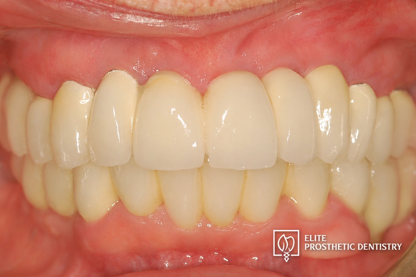 After: additional retracted intraoral view following staged implant reconstruction, lower-arch restoration, and coordinated full-mouth restorative treatment