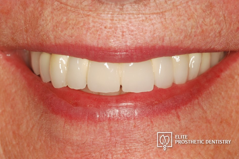 After: How a Loose Upper Bridge and Aging Crowns Were Rebuilt with Staged Implant and Crown Reconstruction