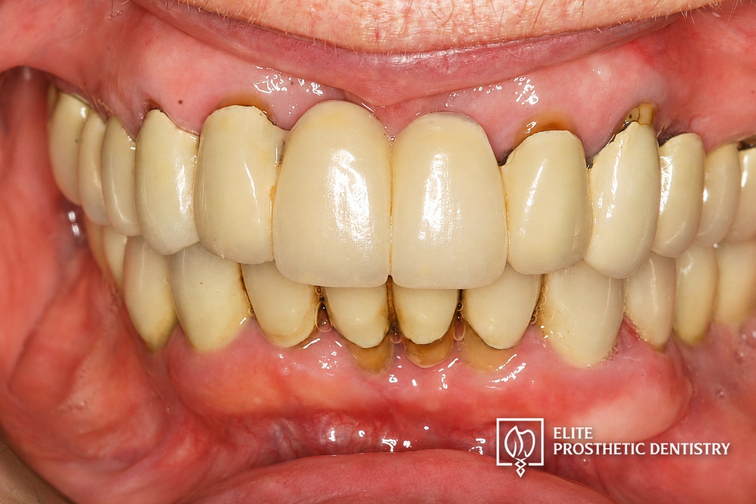 Before: additional retracted intraoral view documenting aging bridgework, compromised restorations, and the extent of restorative breakdown