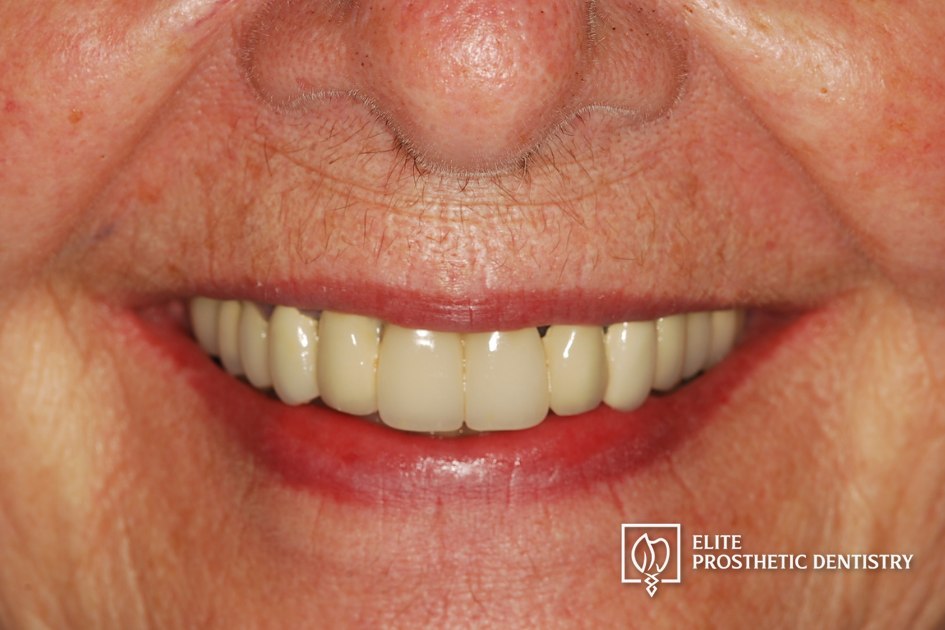 Before: How a Loose Upper Bridge and Aging Crowns Were Rebuilt with Staged Implant and Crown Reconstruction