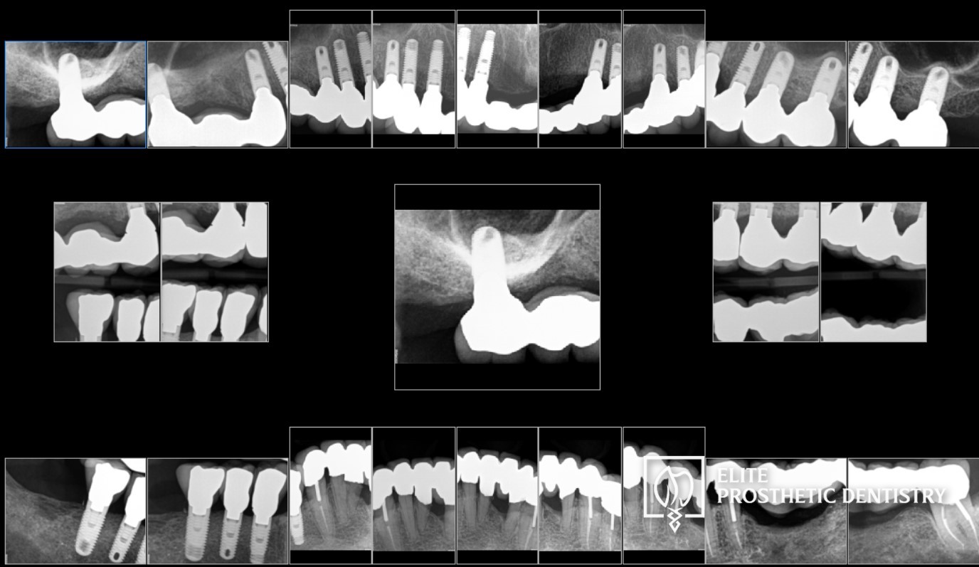 Post-treatment full-mouth radiographic series evaluating the seating of the final restorations, the custom implant abutments, the supporting implant foundations, and the bone response around the staged implant reconstruction at Elite Prosthetic Dentistry in Washington, DC