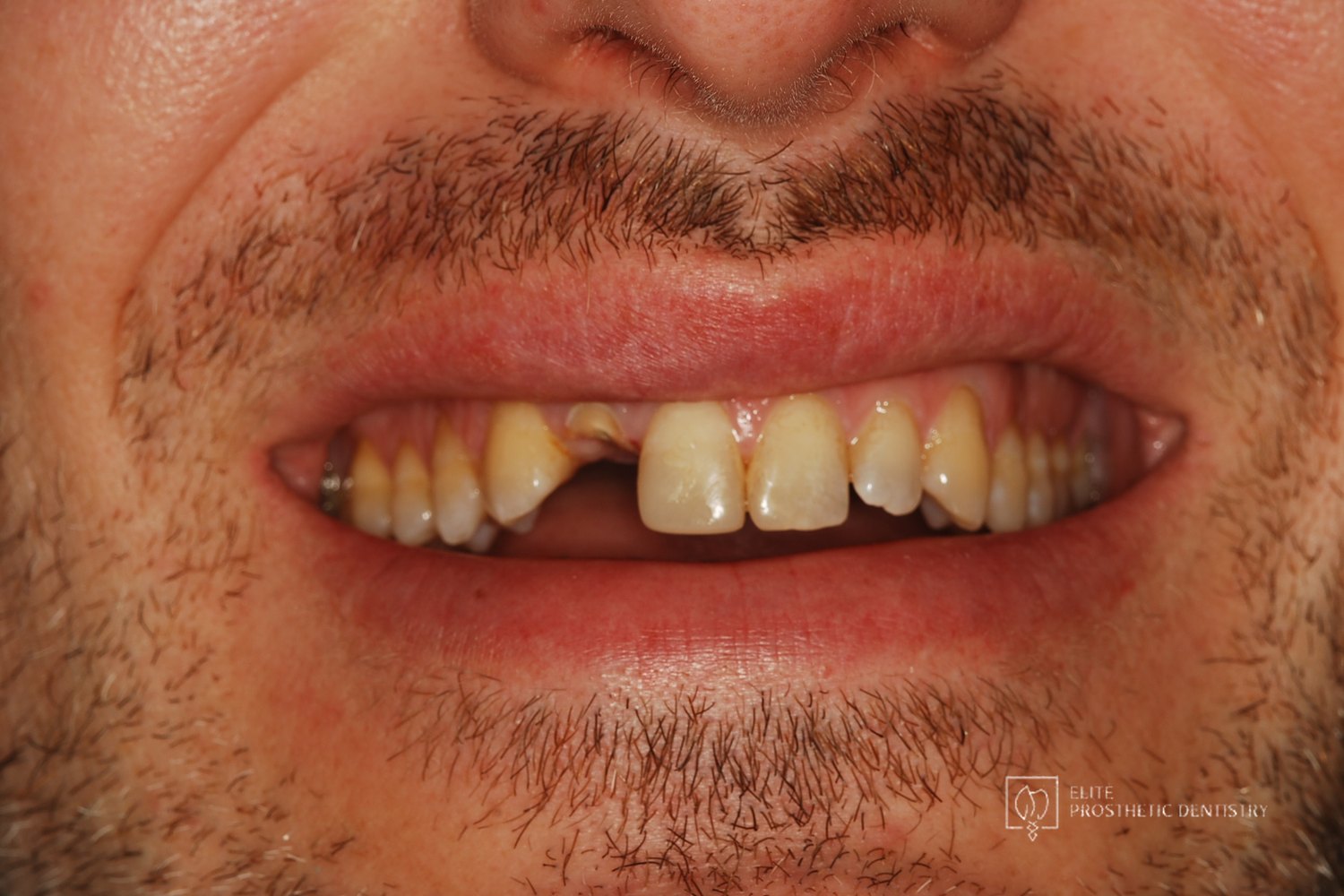 Pre-treatment smile showing how the broken front tooth read in everyday expression.